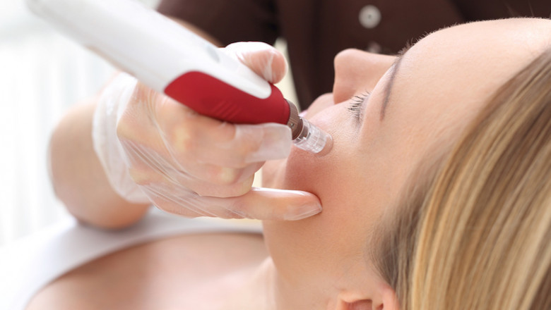 Facial Rejuvenation using 'vampire' procedures