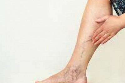 Scrutinize the Best Varicose Vein Treatment For You!