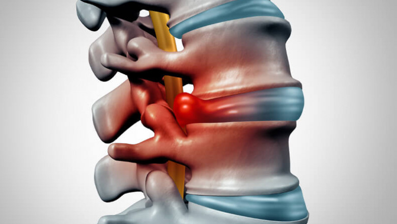 Varieties of Herniated Discs