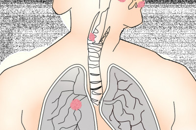 What are the symptoms and signs of lung cancer?