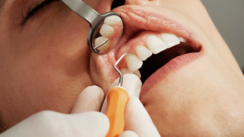 Finding The Right Dentist for Dental Implants India