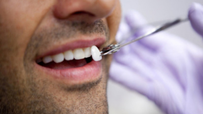 What Is The Cost Of Lumineers Procedure?