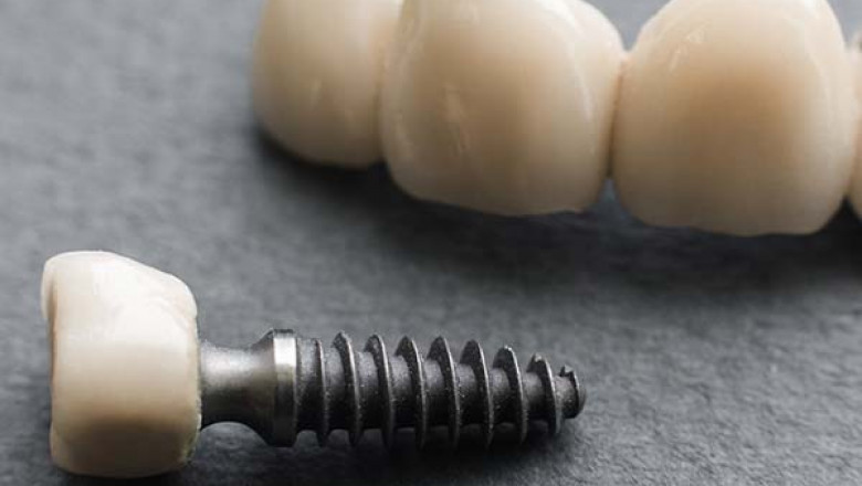 How Does Dental Restoration Works?