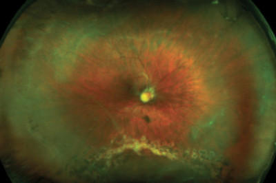 Pediatric Vitrectomy Market Projected To Be Resilient During 2027