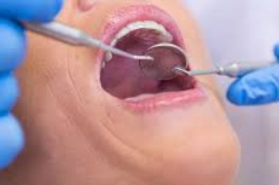 Dental Implants in Houston Tx