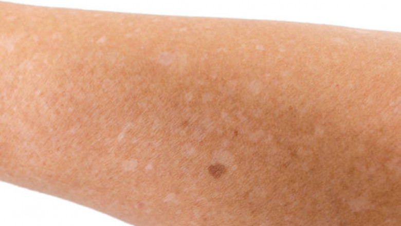 Everything to Know about Idiopathic guttate hypomelanosis