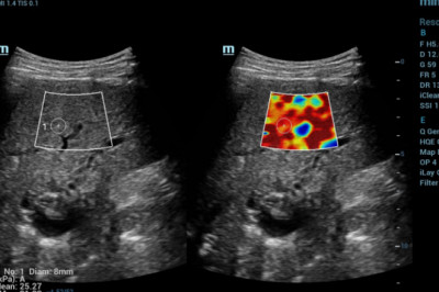 Elastography Imaging Market to Witness Increasing Product Launches Even During the Coronavirus Crises; MRFR Releases the Forecast for 2019-2027