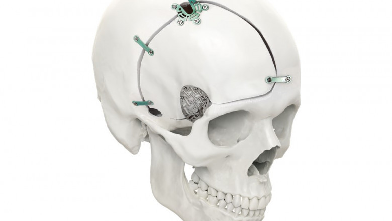 Global Cranial Fixation and Stabilization Market Outlook 2021- Shares, Opportunities, Development Status, Key Findings and Growth Forecast 2027