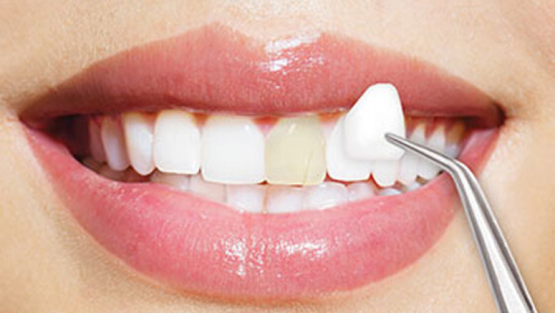 Dental Implant Dentist in Houston Tx