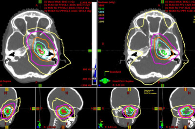 Intensity-Modulated Proton Therapy Market Forecast to 2028 - COVID-19 Impact and Global Analysis
