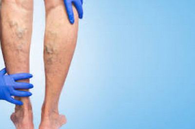 TOP 4 WAYS TO DEAL WITH THE VEIN PROBLEM