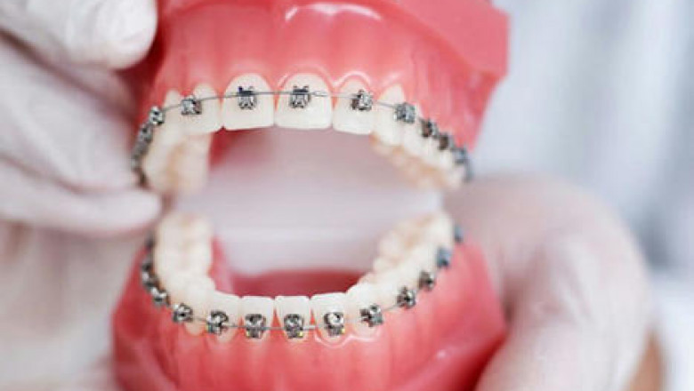 How Does An Orthodontist Help In Getting Straight Teeth?