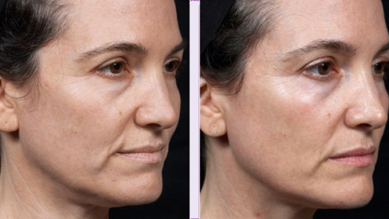 Skin Tightening Market Overview, Analysis forecast to 2026