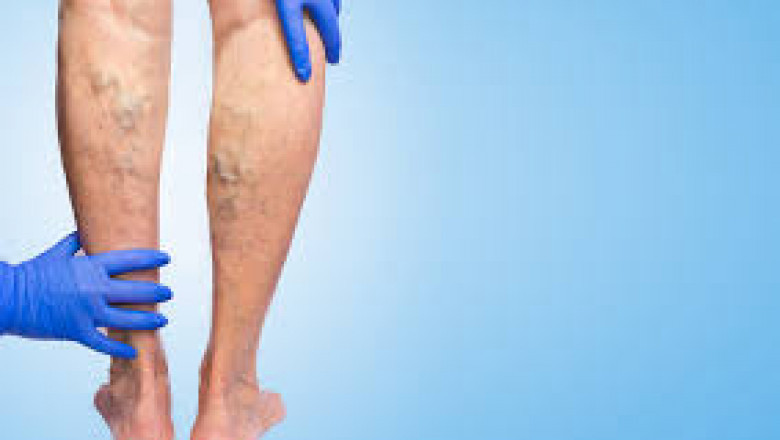 Top 5 Factors That Makes You Prone To Get Vein Diseases