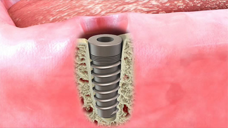 Dental Implant Restoration