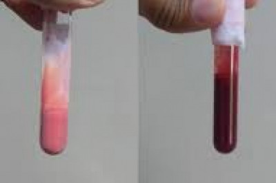 There's no FDA-approved Familial Chylomicronemia Syndrome Treatment