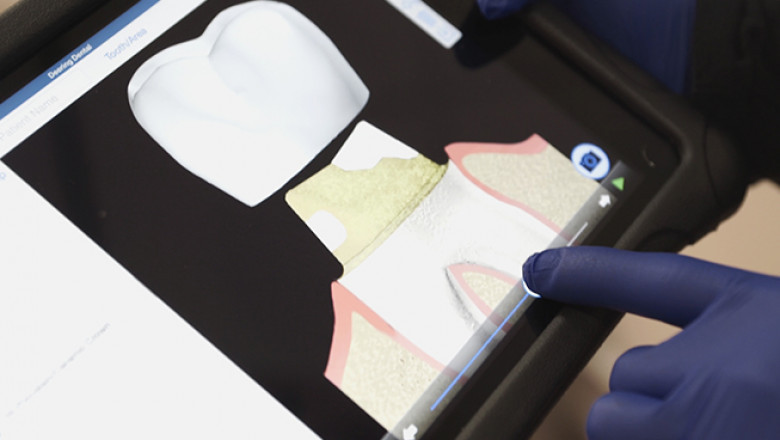 Advantages You Can Get with Invisalign Braces