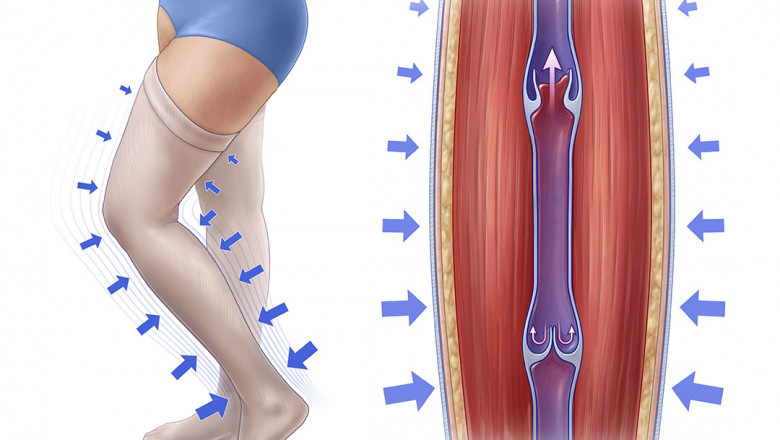 Compression Therapy Market Segments, Share, Growth, Trends, COVID 19 Impact Analysis, by 2027
