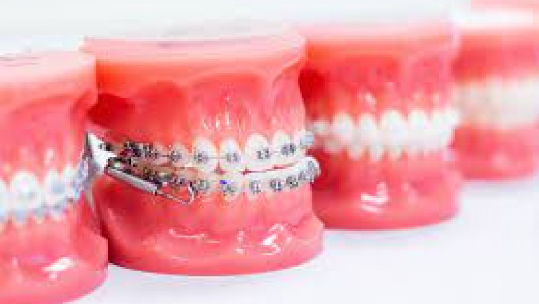 Gum Abscess: How To Get The Treatment Effectively?