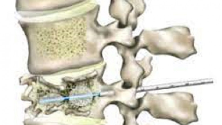 Kyphoplasty Market : Features, Opportunities and Challenges | IZI Medical Products, ZAVATION, Zimmer Biomet, Parallax Health Sciences, Inc.