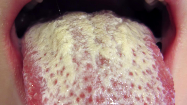 Yeast Infections Market is Projected to Register 5.2% CAGR by 2021 | Technology Advancement, Upcoming Trends, Industry Share, Growth Analysis