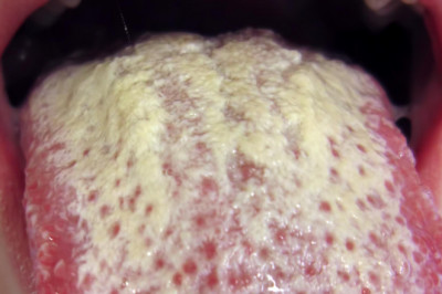 Yeast Infections Market is Projected to Register 5.2% CAGR by 2021 | Technology Advancement, Upcoming Trends, Industry Share, Growth Analysis