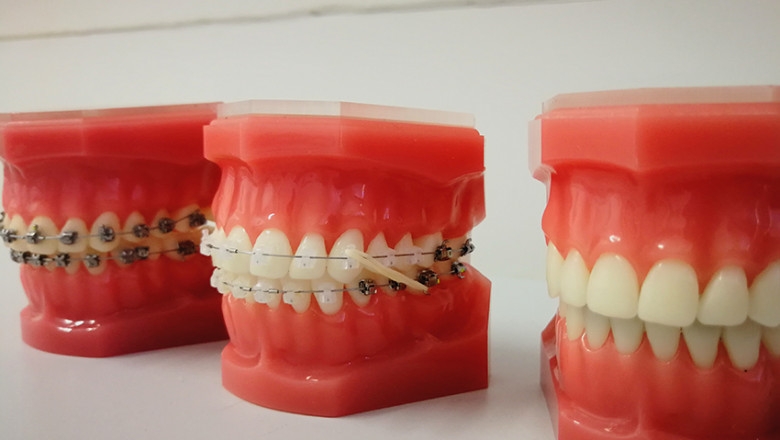 dental implants near me