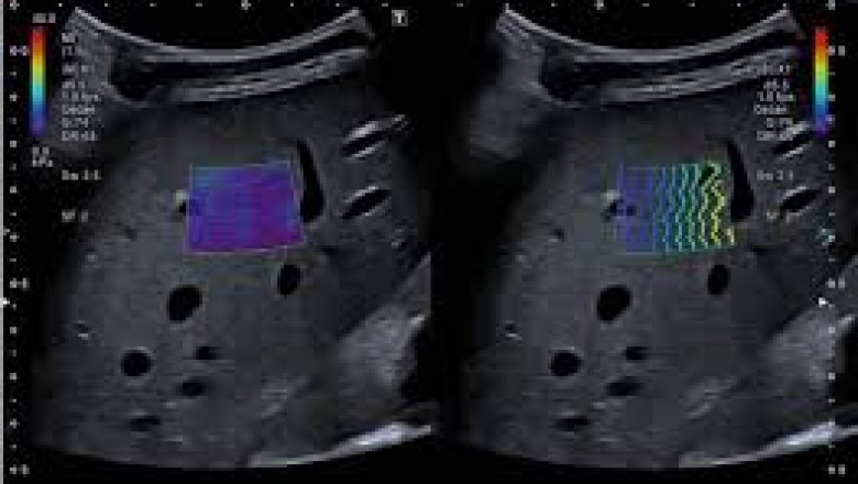 Elastography imaging Market Demand Forecast, Opportunities, Current Trends, Challenges, Growth Analysis, Company Profiles, Industry Size 2027 | Koninklijke Philips N.V., Mindray Medical International Ltd., Resoundant Inc., Hi