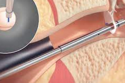 One of the devices on the rise in the Tympanostomy Products Market is the eon Medtech palm