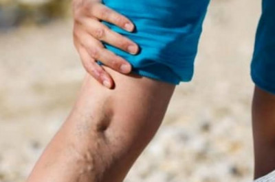 Can Varicose Veins Become Critical? Know-How