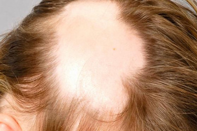 The most common therapies available for the Androgenetic Alopecia Treatment are minoxidil and 5-alpha reductase inhibitors