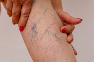 Find the Best Vein Clinic in Long Island