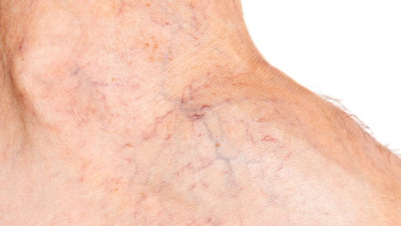 Woodland Park Varicose Vein Treatment Near Me