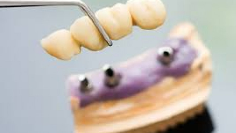 All You Need to Know About Dental Implant
