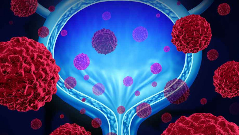 Bladder Cancer Market Growth Forecast, Demand Analysis, Business Opportunities, Sales Revenue | 2027