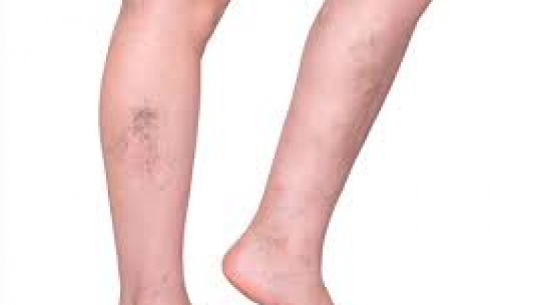 Varicose Veins; Two Best Treatment Options To Eliminate Them.