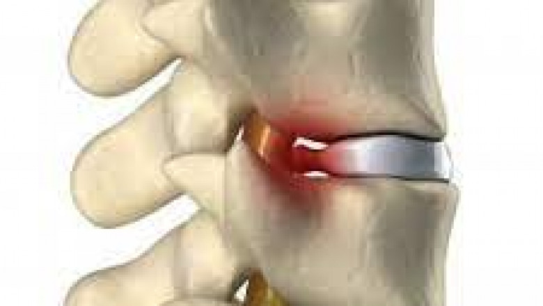 Nonsurgical Treatment for Spine & Compression fracture