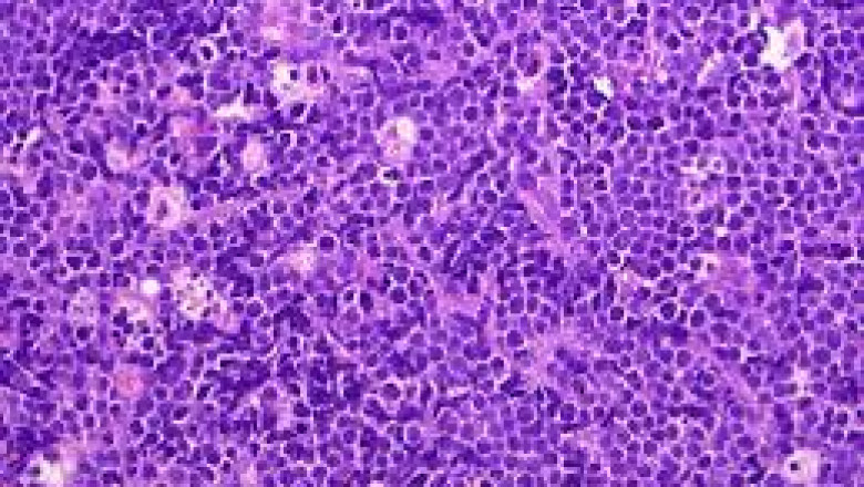 Burkitt Lymphoma Treatment may include surgery, radiation therapy, chemotherapy, immune system suppressors such as interferon-gamma