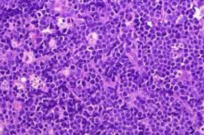 Burkitt Lymphoma Treatment may include surgery, radiation therapy, chemotherapy, immune system suppressors such as interferon-gamma