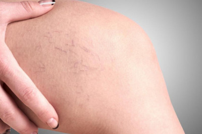 Surgical Treatments To Get Rid Of Veins