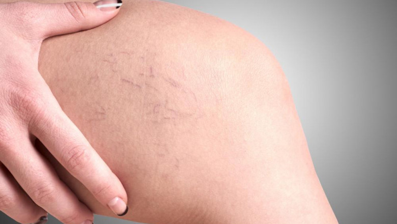 Do Spider Veins Cause Soreness?