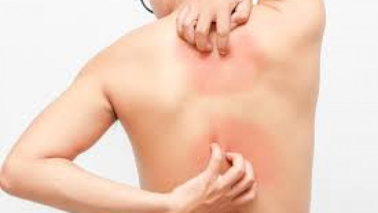 NASDAQ Company in the Multi-Billion Dollar Market Treating Skin Disorders Including Skin Cancer: Jupiter Wellness, Inc. (NASDAQ: JUPW)