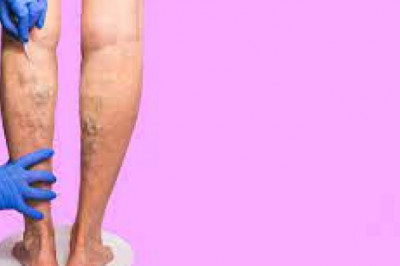 Spider vein Treatment: Do Natural Remedies Produce Effective Results?