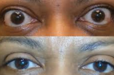 Thyroid eye disease treatment is divided into two stages