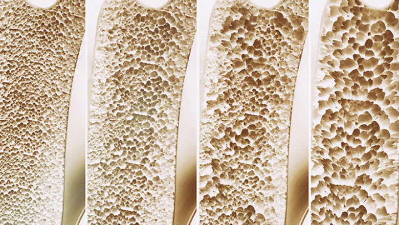 5 Crucial Things to Know About Osteoporosis