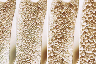 5  Crucial Things to Know About Osteoporosis