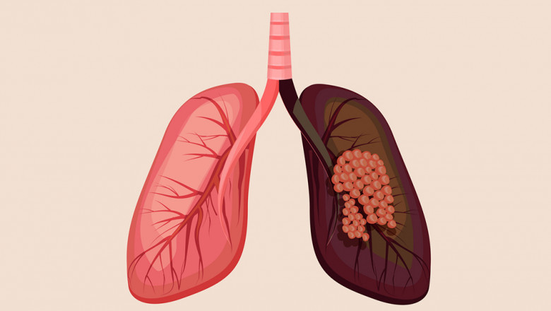 Lung Cancer Decortication in New Delhi-Meddco