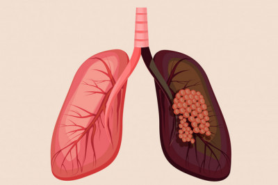 Lung Cancer Decortication in New Delhi-Meddco