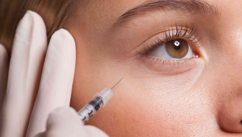 5 Common Questions About Botox Injections