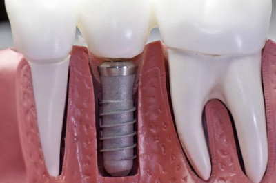 Intramucosal Implants Effects and Techniques